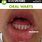 Mouth Warts Treatment