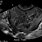 Multi Fibroid Uterus