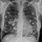 Multiple Lung Nodules