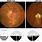 Non-Arteritic Anterior Ischemic Optic Neuropathy