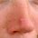 Nose Acne