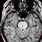 Occipital Lobe MRI