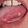 Oral Cancer Lesions On Tongue