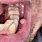 Oral Mucosa Fibroma