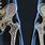 Osteoporosis Hip