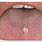 Papilloma of Tongue