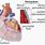 Pericardial Window Drain