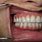 Permanent Teeth Implants
