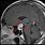 Pituitary Gland Tumor MRI