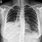 Pneumonia Chest X-Ray