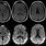 Prion Disease MRI