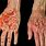 Psoriasis vs Eczema On Hands