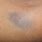 Purple Bruises On Arm