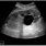 Renal Cyst Ultrasound