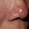 Rosacea Nose Bumps