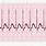 SVT Rhythm EKG