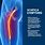 Sciatic Nerve Pain in Buttocks