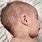 Skin Rashes in Babies