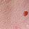 Skin Tag Infection