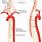 Spinal Cord Arteries