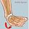 Sprain Injuries