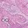 Squamous Cell Bladder Cancer