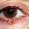 Squamous Cell Carcinoma of Eyelid