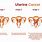 Stages of Endometrial Cancer