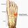 Stress Fracture Foot Metatarsal Bone