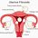 Submucosal Fibroids Uterus