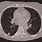 Subpleural Lung Nodule