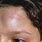 Swollen Forehead