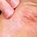 Symptoms of Eczema in Adults