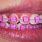 Teal and Hot Pink Braces
