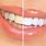 Teeth Whitening Pictures