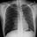 Tension Pneumothorax Radiology