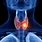Thyroid Cancer Tumor