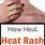 Treat Heat Rash