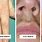 Types of Skin Warts