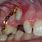 Unerupted Teeth