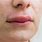 Upper Lip Swelling