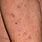 What Do Scabies Look Like On Humans