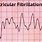 What Is Ventricular Fibrillation