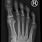 X-ray of Right Foot