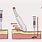 Z-track Paracentesis