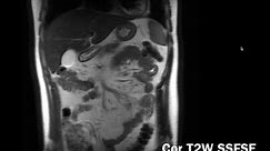 Introduction to Abdominal MRI: Background, Pulse Sequences, Normal Appearance (Body MRI, Abdo MRI)