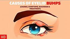 The Surprising Causes of Eyelid Bumps You Never Knew About!