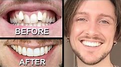INVISALIGN REVIEW - everything you need to know