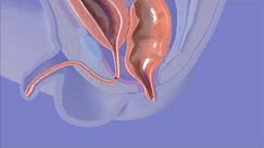 Anorectal Malformation Surgery