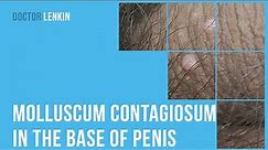 😟 Molluscum contagiosum in the base of penis